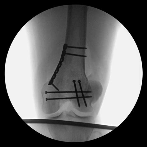 Femur Anteromedial Approach Approaches Orthobullets