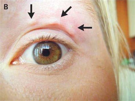 Mysterious Itchy Lump On Womans Face Is A Parasitic Worm Moving Around
