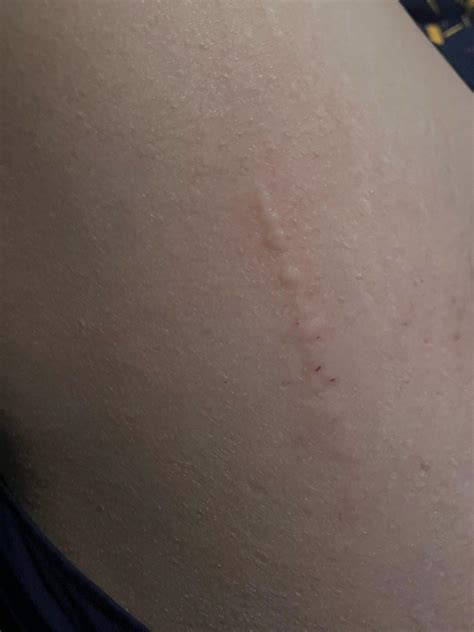 Linear Itchy Rash What Is This From Rdermatologyquestions