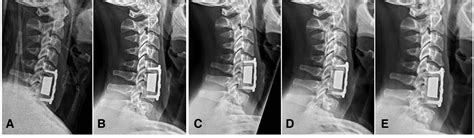 Anterior 1 2 Level Cervical Corpectomy And Fusion For Degenerative