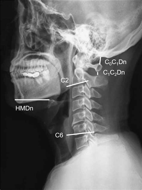 Lateral Cervical X Ray Film In The Neutral Positions Hmdn The