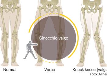 Patologie Del Ginocchio Patologie E Cura Ryakos Fisioterapia