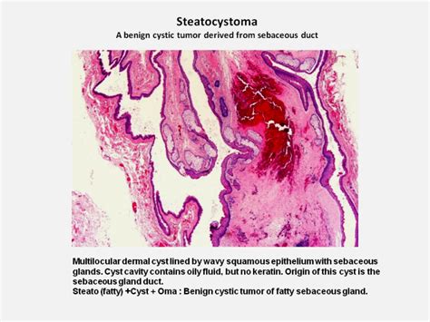 Steatocystoma Dr Sarmas Dermpath And Other Pathology Topics