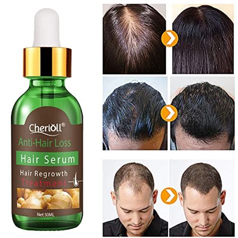 Hair Growth Serumhair Loss Andhair Thinning Treatmenthair Serum