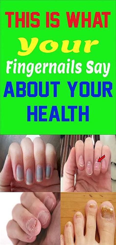 This Is What Your Fingernails Say About Your Health In 2020 Nail