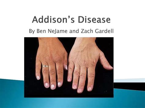 Ppt Addisons Disease Powerpoint Presentation Free Download Id1412672