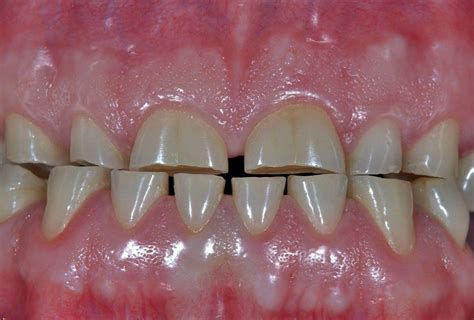 wornout teeth elite dental care