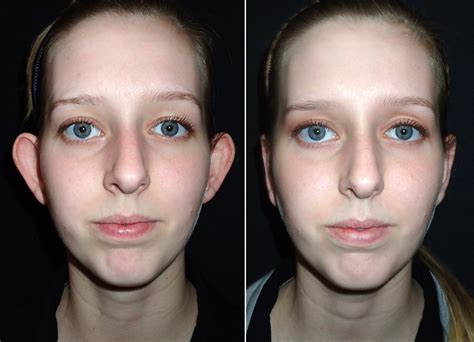 Protruding Ears Gallery Richmond Va Cosmetic Facial Surgery