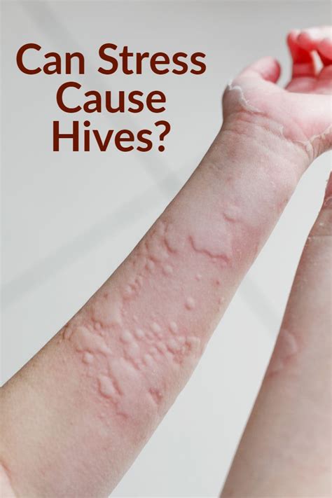 Can You Get Hives From Stress Healthy Tips Stress Causes Hives Remedies Health