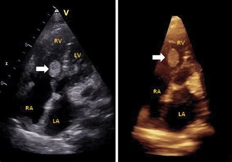 2d And 3d Echocardiography Showed A 15 Mm×11 Mm Mass In The Right