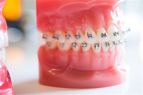 How Do Teeth Move With Braces Freeman Orthodontics