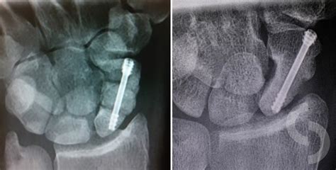 Scaphoid Non Union Treated With The Bone Graft Inserted Between Two Non