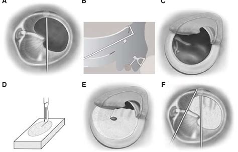 Three Point Fix Tympanoplasty A A Pocket Was Made By Elevation Of