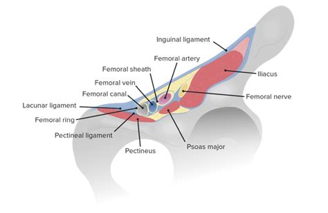 marzo Lesionarse Perth Blackborough hernia femoral anatomia semanal Año