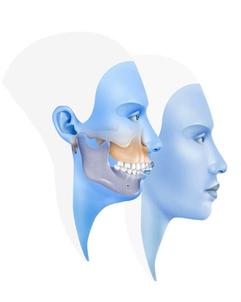 Orthognathic Jaw Surgery Welcome To Aureum Aesthetics