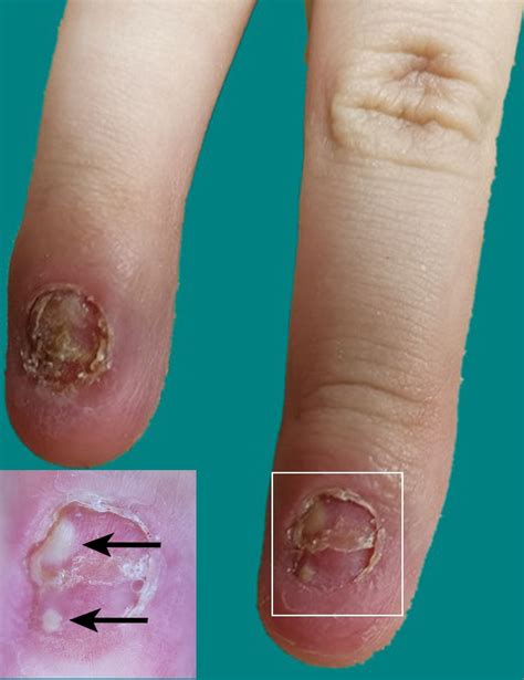 An Unusual Presentation Of Psoriasis The Bmj