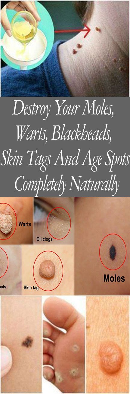 Destroy Your Moles Warts Blackheads Skin Tags And Age Spots