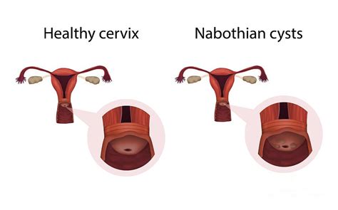 Nabothian Cysts And Healthy Cervix Photograph By Veronika Zakharova