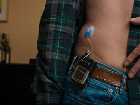 The Worlds First Artificial Pancreas Just Got Approved