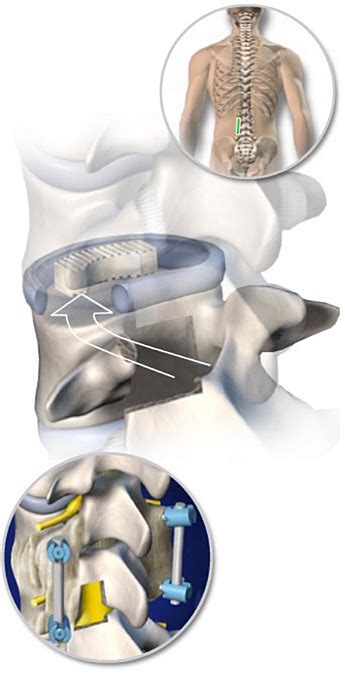 Tlif Transforaminal Lumbar Interbody Fusion Central Coast Orthopedic Medical Group
