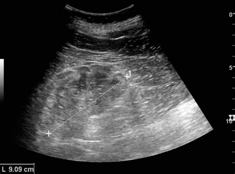 In the later stages, your kidneys must work harder to get rid of waste and may stop working altogether. Kidney Ultrasound Clinic - CRCTC Public - Columbia River ...