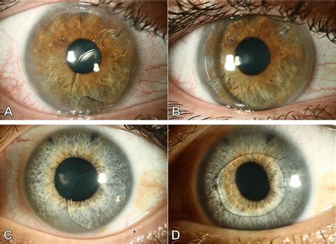 Two Cases With Subluxation Of An Iris Fixated Phakic Anterior Chamber