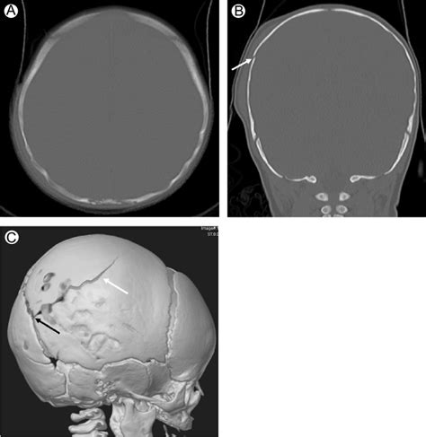 Subtlety Of Fractures In The Plane Of Imaging Axial Ct Image In Bone