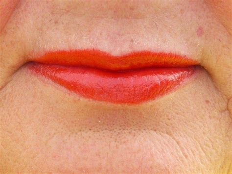 Skin Discoloration Around Mouth Lip Wrinkles Lip Wrinkle Treatment