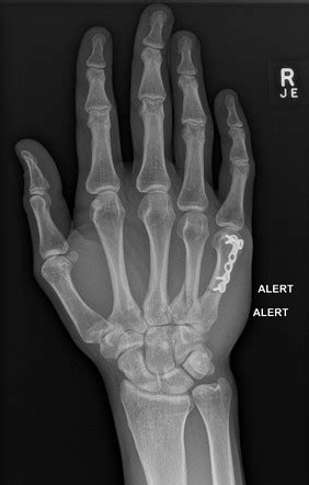 Boxer Fracture Radiology Reference Article Radiopaedia Org