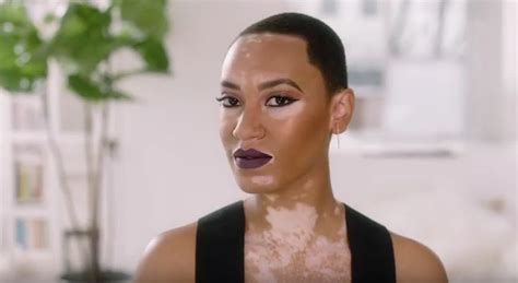 Covergirls First Model With Vitiligo Amy Deanna Stars In New