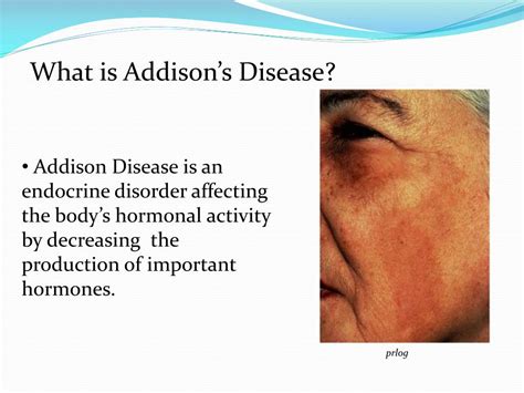 All About Addison S Disease Symptoms Causes And Treatment My Xxx Hot Girl