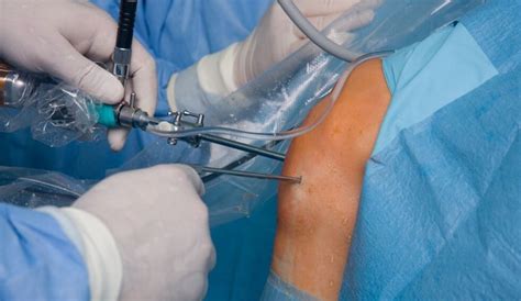 Latest Minimally Invasive Surgery Options In Orthopaedics Sports Medicine And Orthopedic