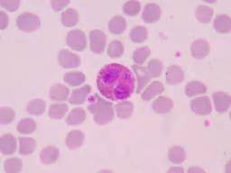 Start studying absolute eosinophil count. Eosinophils: What are eosinophils and eosinophilia