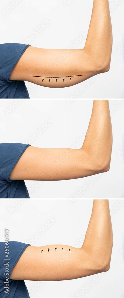Saggy Skin Removal And Arm Before And After Toning Exercises Stock