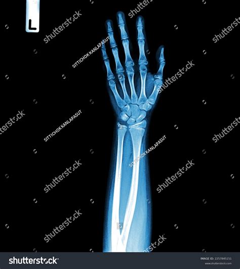 Film Xray Hand Ap Show Normal Stock Photo 2257845151 Shutterstock