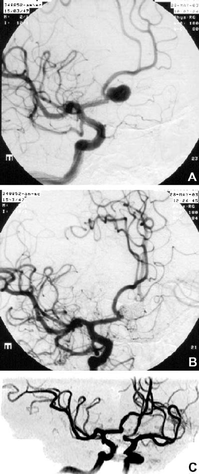 A 48 Year Old Woman With An Unruptured 10 Mm Acoa Aneurysm Successfully Download Scientific