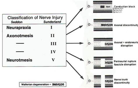 Classification And Wallerian Regeneration