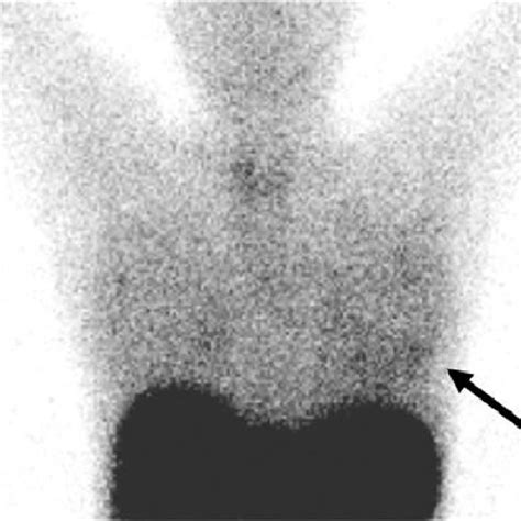 Ultrasound Representation Of A Metastatic Lymph Node Of The Left Axilla