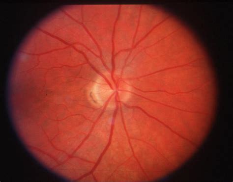 Normal Appearing Optic Disc Is Seen In All Cases Of Acute Posterior