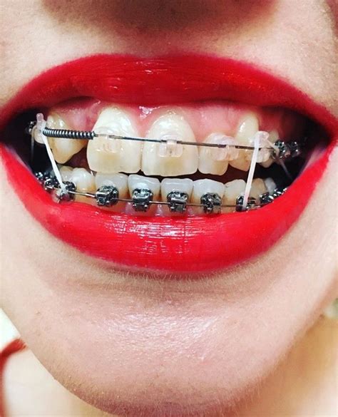 The Ultimate Guide to the Parts of Braces - Frey Orthodontics