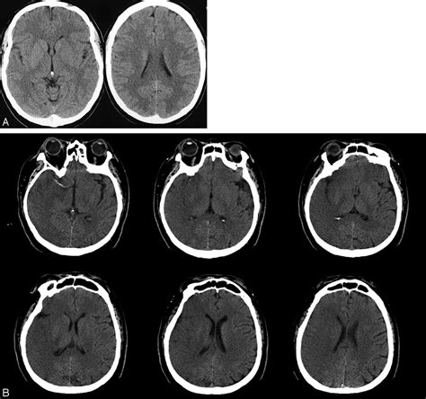 Using The Baseline Ct Scan To Select Acute Stroke Patients For Iv Ia