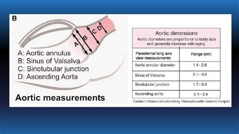 Echo Assesment Of Aortic Stenosis And Regurgitation