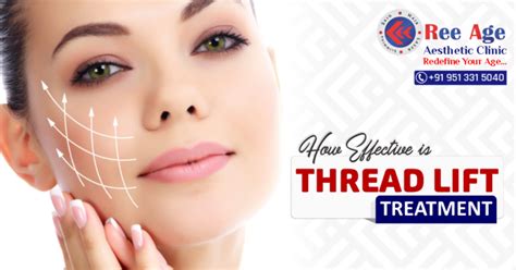 How Effective Is Thread Lift Treatments