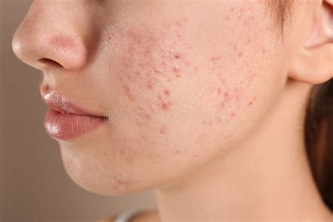 Teenage Girl With Acne Problem On Beige Closeup Stock Image Image Of