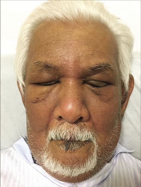 An Intriguing Case Of Persistent Facial Swelling Indian Journal Of