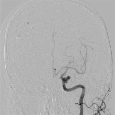 Dissecting Aneurysm Of The V4 Segment Of The Vertebral Artery Image