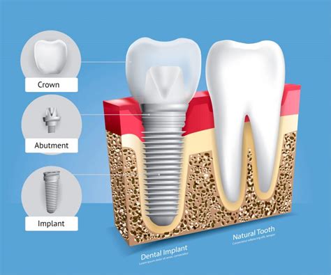 Dental Implants Cibolo Free Consultation Smile With Confidence