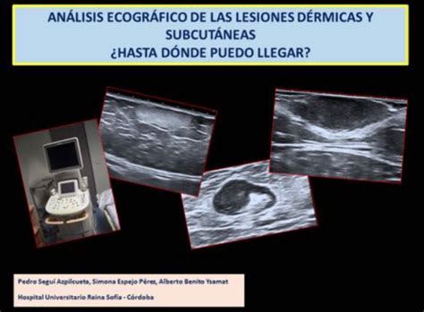 Analisis Ecografico De Las Lesiones Dermicas Y Subcutaneas Seram