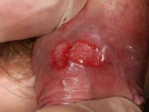 Genital Herpes Images DermNet
