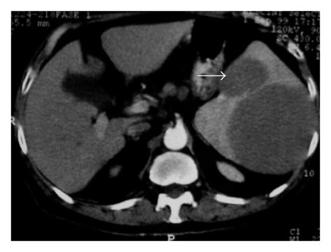 Abdominal Manifestations Of Lymphoma Spectrum Of Imaging Features